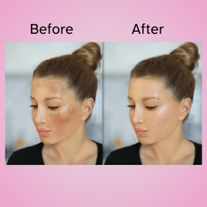 P-vita Melasma Cream